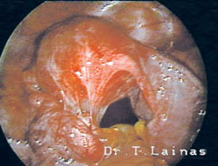 Extended pelvic adhesions, a result of severe inflammation (laparoscopic image). 
